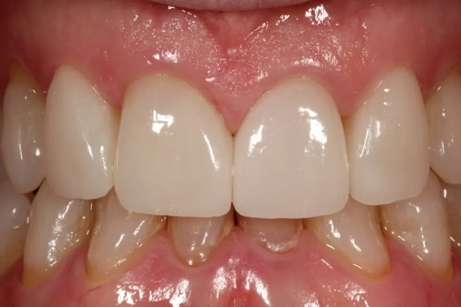 After: In-office bleaching and four porcelain laminates.