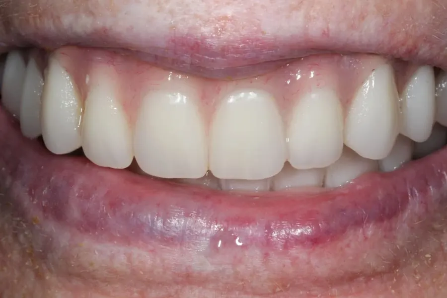 After: Full upper and lower implant restoration.