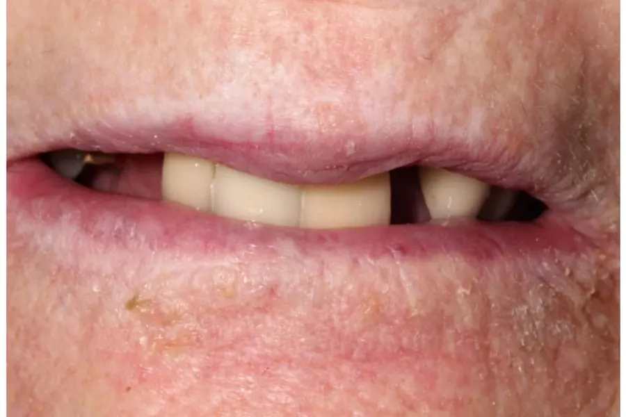 Before: Full upper and lower implant restoration.