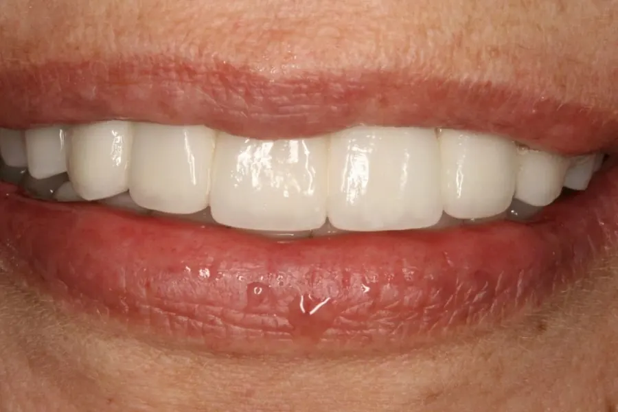 After: Full mouth rehabilitation.