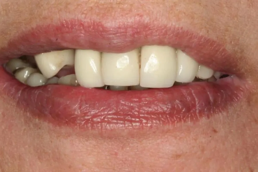 Before: Full mouth rehabilitation.