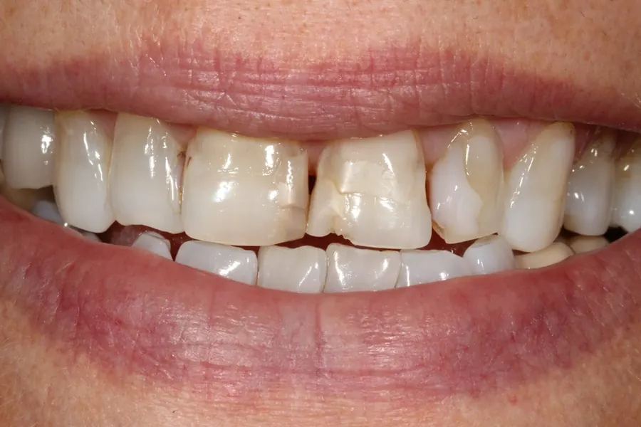 Before: Porcelain laminates.