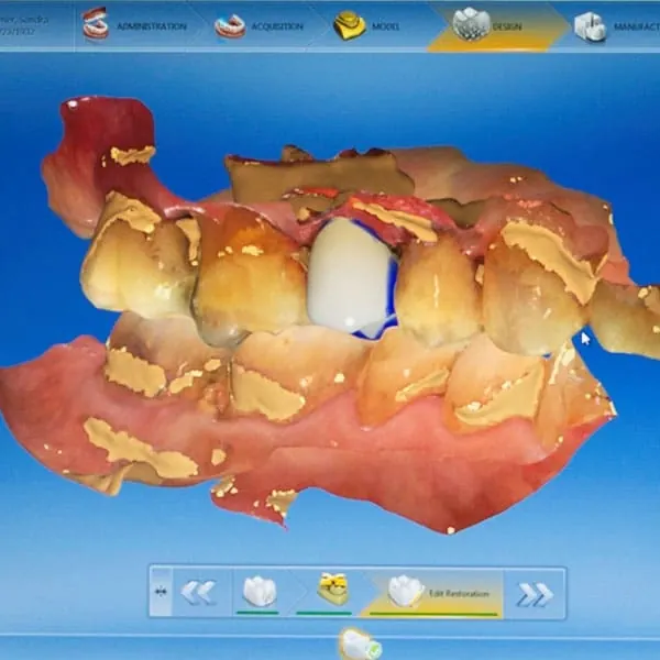 A crown being designed in the CEREC software on the office screen.