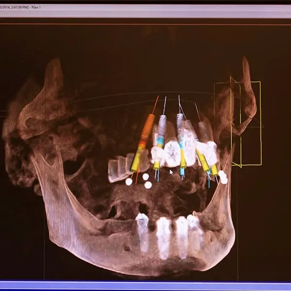 A 3D cone beam scan with planned implants on the office monitor.